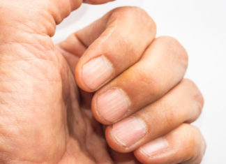 Líneas en las uñas podrían revelar que te hace falta este nutriente