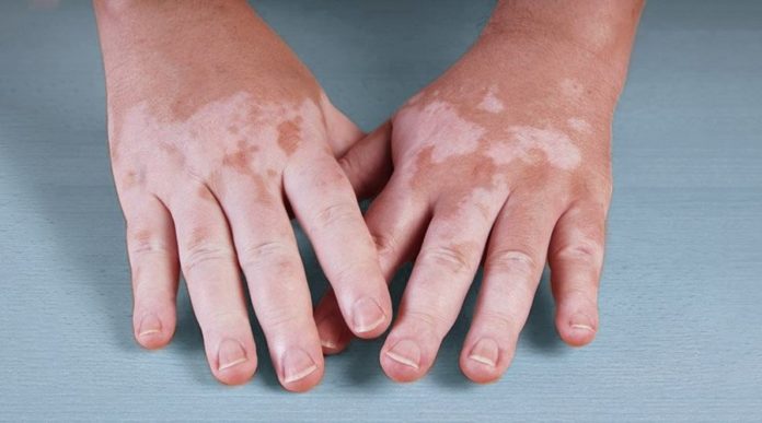 vitiligo