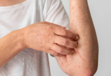 Deja el 2023 188 casos de dengue