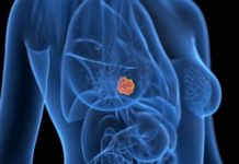 La herramienta de inteligencia artificial que detecta tumores de cáncer que no pueden ver los médicos