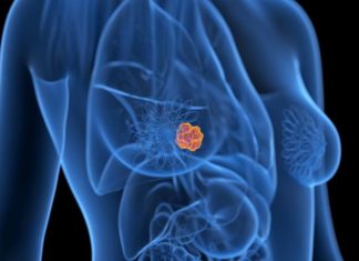 La herramienta de inteligencia artificial que detecta tumores de cáncer que no pueden ver los médicos