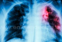 Alertan contra la tuberculosis, ya van 285 casos