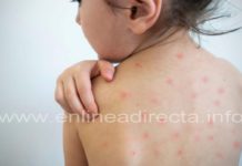 Varicela se dispara; más de mil casos