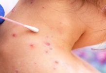 Será el viernes cuando confirmen caso de viruela símica en Matamoros