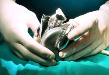 Por primera vez en la historia un corazón de titanio se puso en un cuerpo humano: más que un órgano, parece un motor de auto deportivo