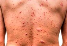 En Tampico fue detectado el primer caso de viruela del mono