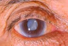 Invitan a ciudadanos checarse la vista y evitar el glaucoma