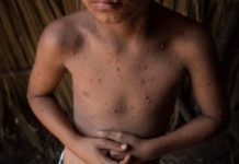 Virus coxsackie cambia, hay ALERTA por casos fuera de temporada y en niños más grandes