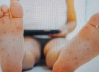 En N. Laredo no hay sarampión, pero recomiendan vacunarse